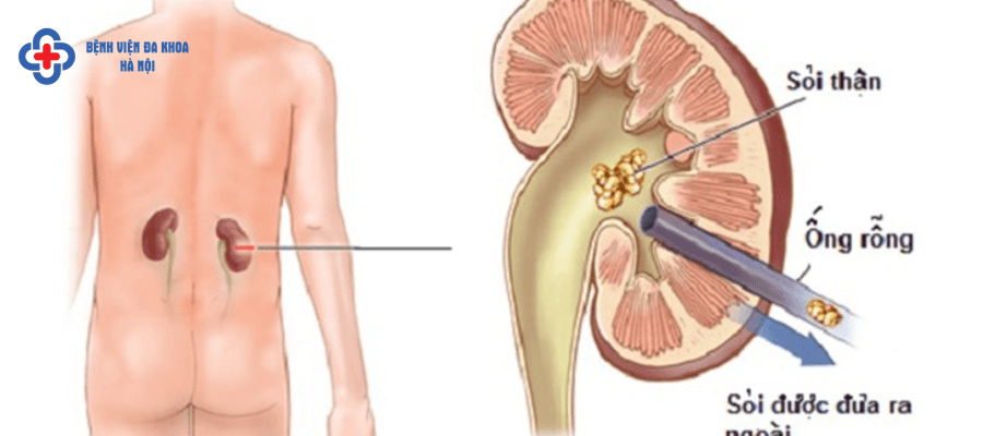 Phương pháp tán sỏi hiện đại