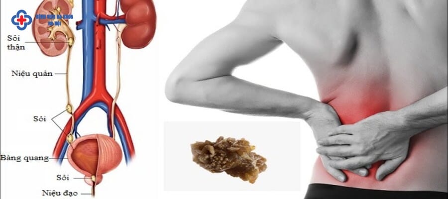 Đau vùng lưng người bệnh luôn khó chịu, mệt mỏi