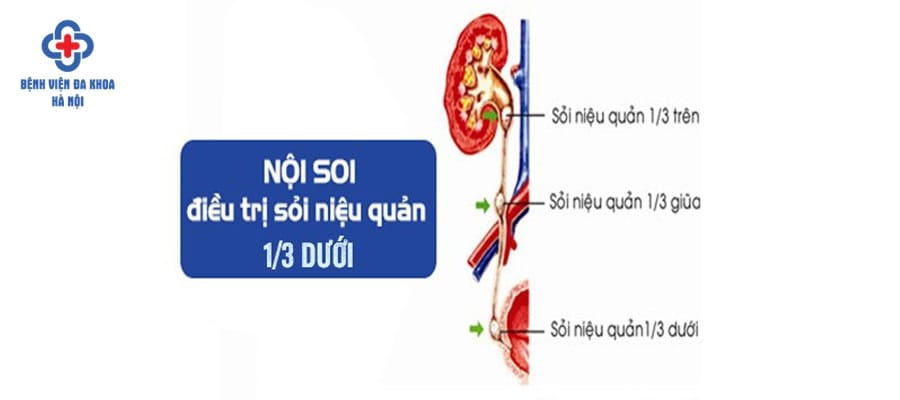 Vị trí của sỏi niệu quản ⅓ dưới