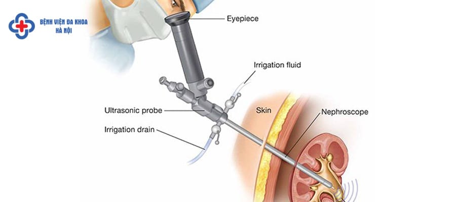 Tán sỏi qua da hay nội soi tán sỏi được ưu tiên sử dụng. dieu tri soi tiet nieu