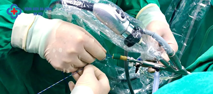 Điều trị tán sỏi 9mm bằng kỹ thuật hiện đại 