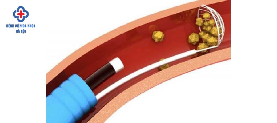 Nội soi tán sỏi có thể lấy sỏi đường tiết niệu hiệu quả
