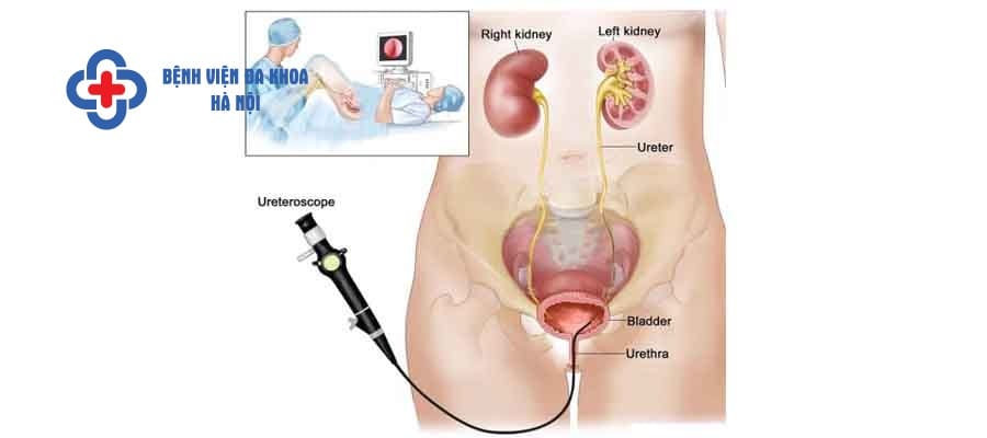 Nội soi ngược dòng tán sỏi có nhiều ưu điểm