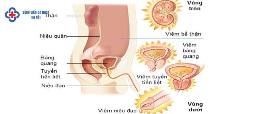 Nên cảnh giác với các dấu hiệu bất thường ở đường niệu dau hieu viem duong tiet nieu