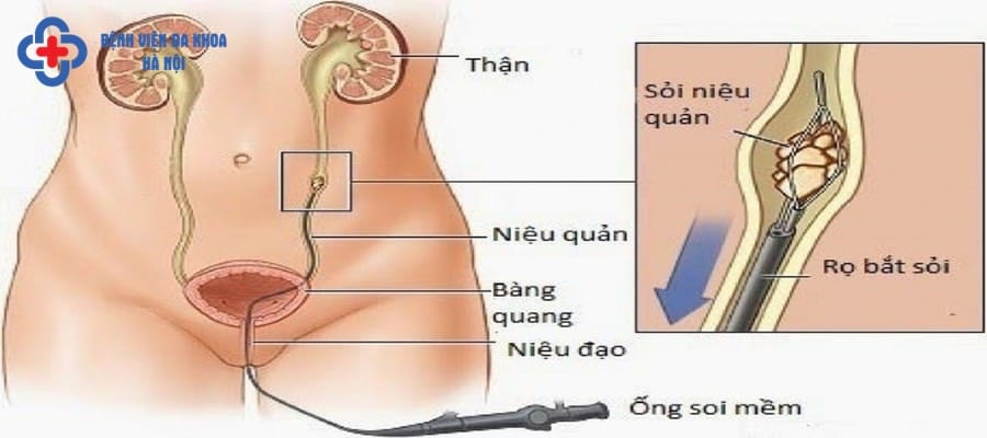 Kỹ thuật hỗ trợ tán sỏi hiệu quả