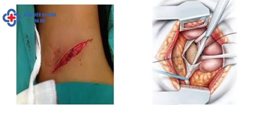 Mô phỏng mổ mở lấy sỏi niệu quản