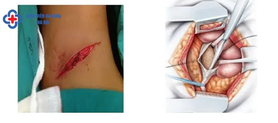 Mô phỏng mổ mở lấy sỏi niệu quản