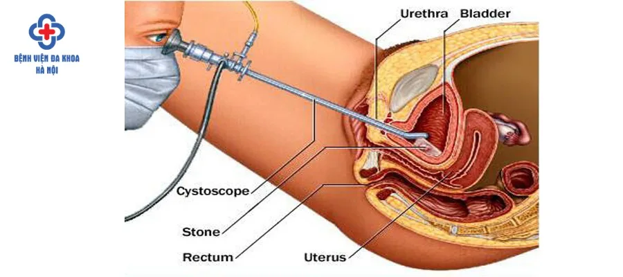 Tán sỏi bàng quang không đau đớn như nhiều người tưởng