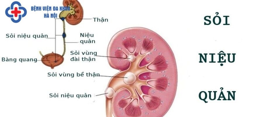 Mổ sỏi niệu quản lấy sỏi ra ngoài