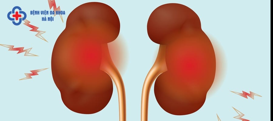 Mổ sỏi thận có thể gây biến chứng nguy hiểm
