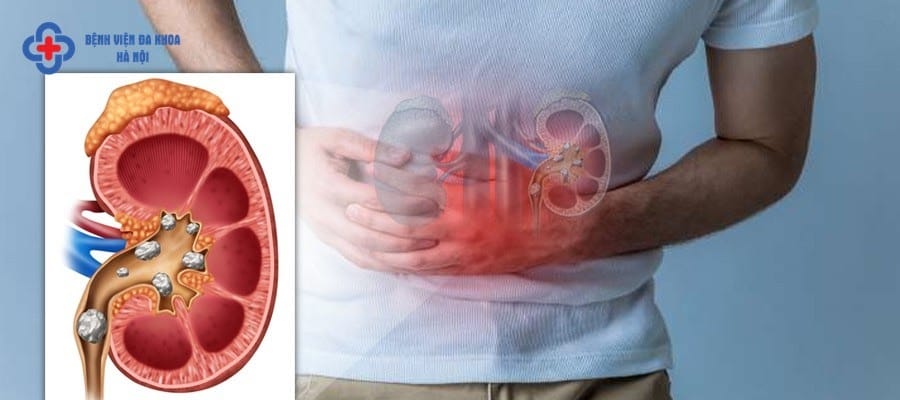 Khi nào cần mổ sỏi thận? Khi nào cần mổ sỏi thận?