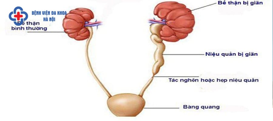 Người bệnh mắc sỏi niệu quản cần được điều trị sớm