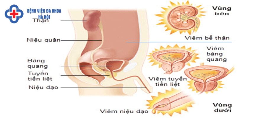 Người mắc bệnh đường tiết niệu có nguy cơ mắc sỏi thận cao
