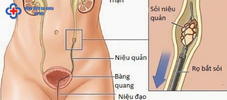 Nội soi tán sỏi ngược dòng điều trị hiệu quả sỏi niệu quản
