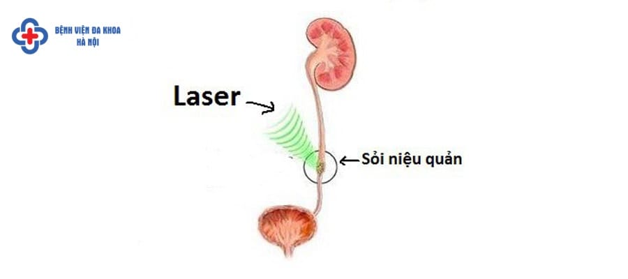 Nội soi tán sỏi niệu quản ngược dòng tại BVĐK Hà Nội noi soi tan soi nieu quan nguoc dong