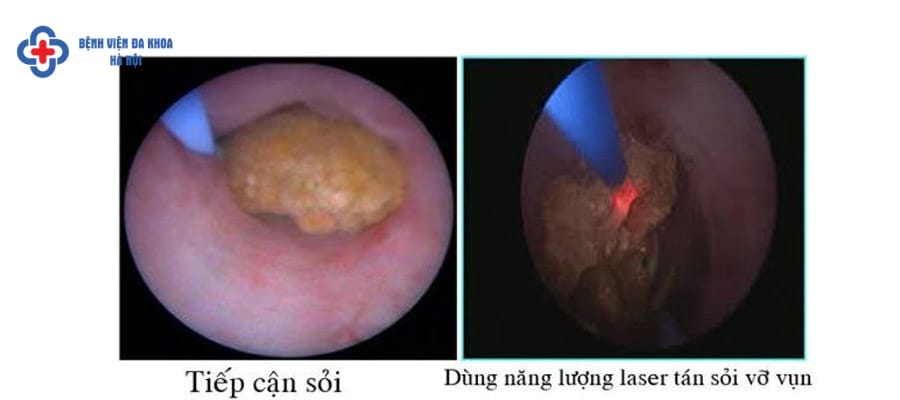 Hình ảnh thực tế khi nội soi tán sỏi niệu quản noi soi tan soi nieu quan