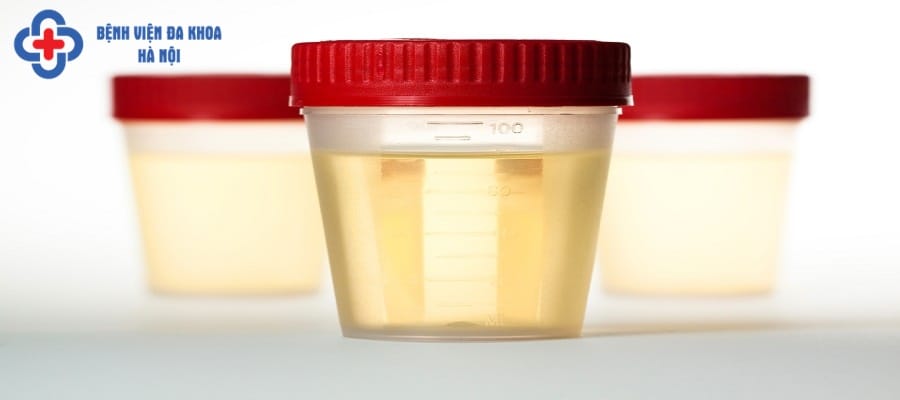 Nước tiểu vẩn đục là triệu chứng thường gặp khi bị nhiễm khuẩn tiết niệu