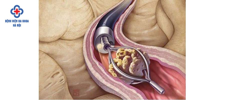 Bác sĩ dùng rọ gắp sỏi để lấy sỏi ra ngoài