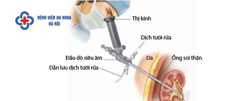 Phương pháp tán sỏi qua da có thể tán được sỏi san hô