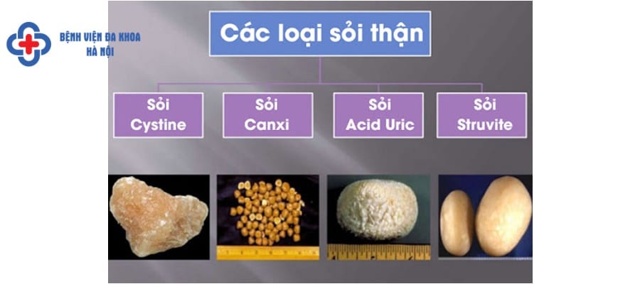 Các loại sỏi thận thường gặp phan loai soi than