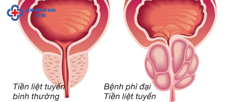 Phì đại tiền liệt tuyến nam giới