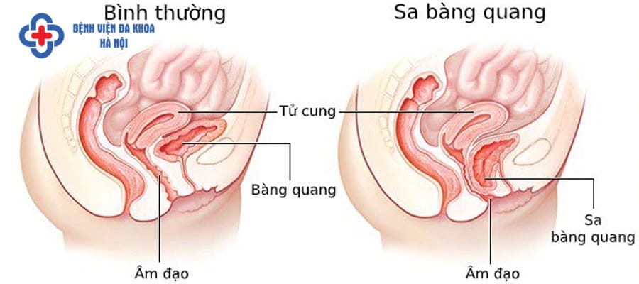 Sa bàng quang gây sỏi bàng quang ở nữ giới