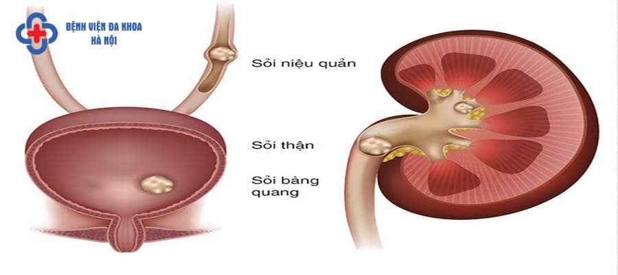 Sỏi niệu quản là gì? Sỏi niệu quản là gì?