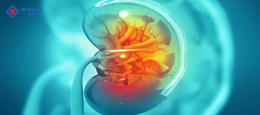 Sỏi 7mm nếu không điều trị có thể gây viêm thận