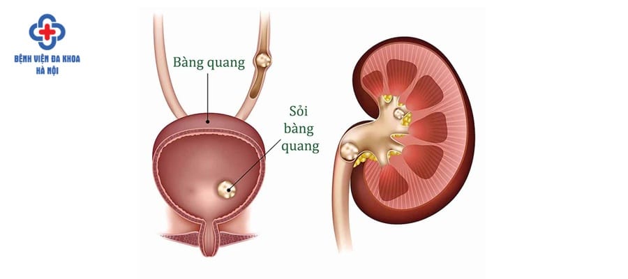 Sỏi bàng quang 5mm còn khá nhỏ