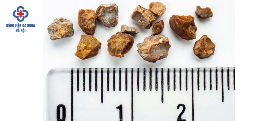 Sỏi bàng quang 7mm là kích thước tương đối lớn