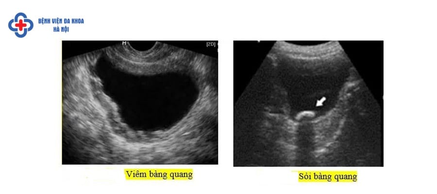 Hình ảnh siêu âm sỏi bàng quang soi bang quang nguy hiem khong