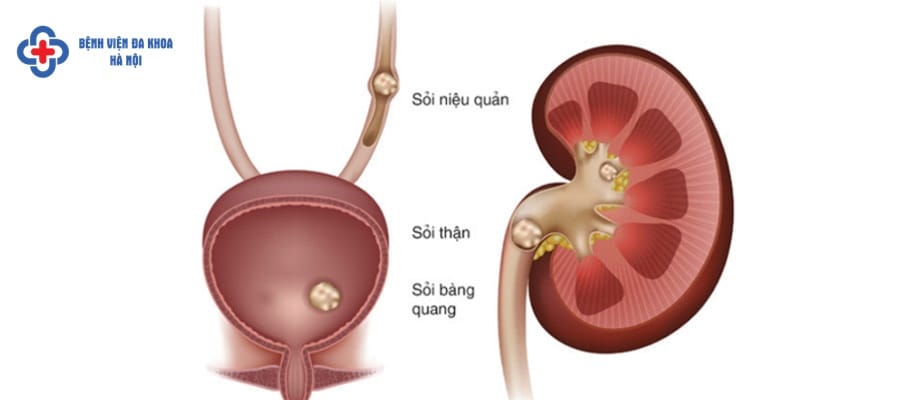 Sỏi bàng quang có thể là do từ thận rơi xuống soi bang quang nen dieu tri som