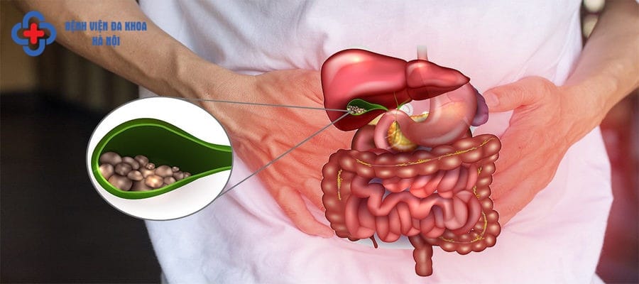 Sỏi cọ xát gây đau cho người bệnh