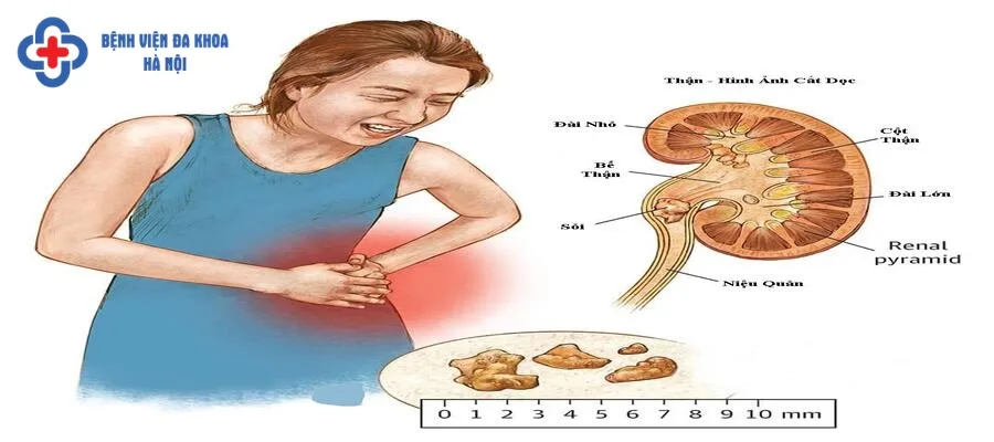 Sỏi cọ xát tại thận gây đau đớn cho người bệnh