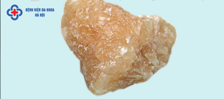 Sỏi cystin