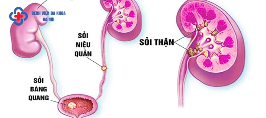 Sỏi di chuyển từ thận tới các vị trí trong hệ tiết niệu