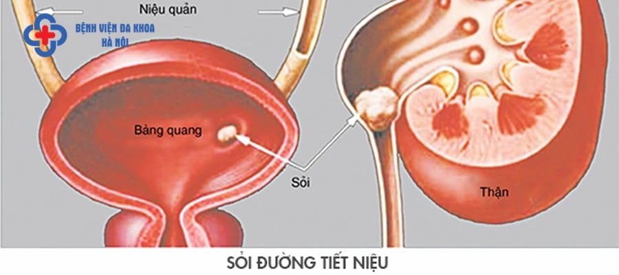 Sỏi đường tiết niệu không còn xa lạ với nhiều người