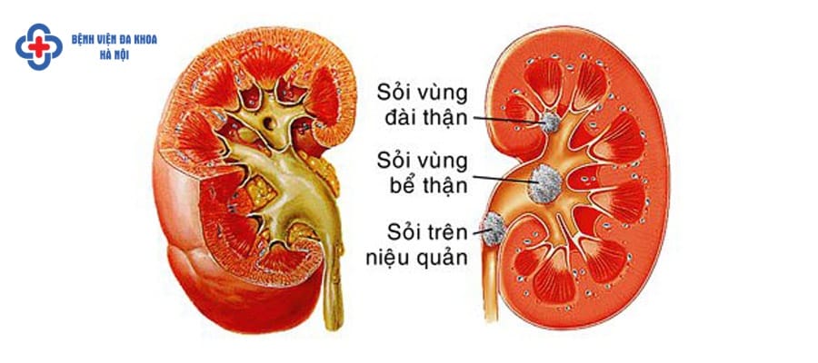 Sỏi đường tiết niệu có nhiều dạng