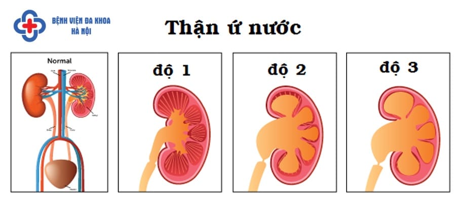 Sỏi gây tắc nghẽn ứ nước tại thận
