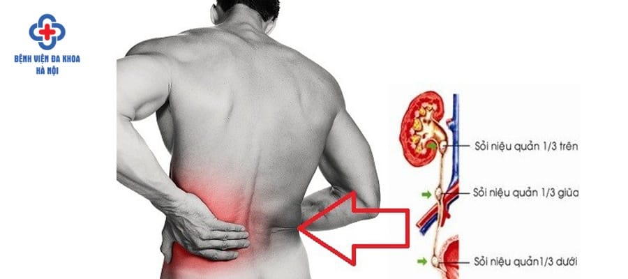 Sỏi niệu quản ⅓ trên có thể gây ra các cơn đau