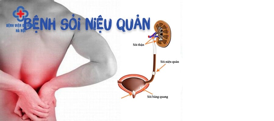 Sỏi niệu quản gây đau đớn vùng thắt lưng người bệnh