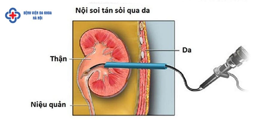 Hình ảnh mô phỏng phương pháp tán sỏi niệu quản qua da