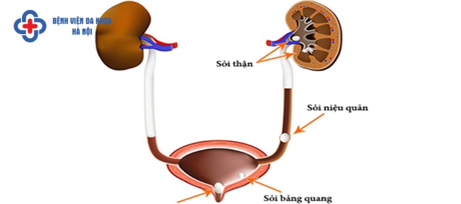 Sỏi niệu quản đoạn dưới bàng quang thường dễ mắc sỏi