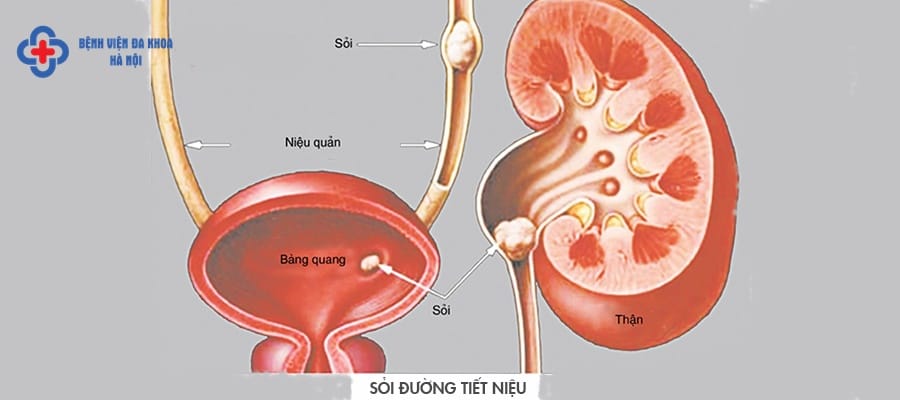 Sỏi niệu quản gây nhiều phiền toái với người bệnh