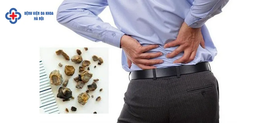 Sỏi niệu quản gây nên nhiều phiền toái