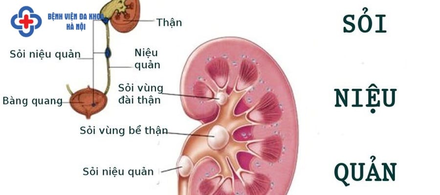 Sỏi niệu quản là căn bệnh phổ biến với tỷ lệ người mắc cao