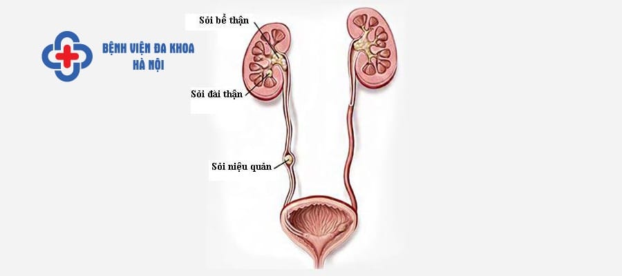 Sỏi niệu quản trái cần được phát hiện sớm