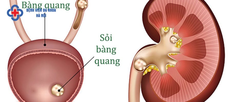 Sỏi rơi từ thận, niệu đạo tới bàng quang