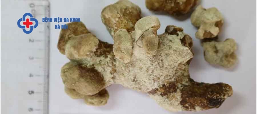 Ca mắc sỏi san hô hiếm gặp nhưng rất nguy hiểm