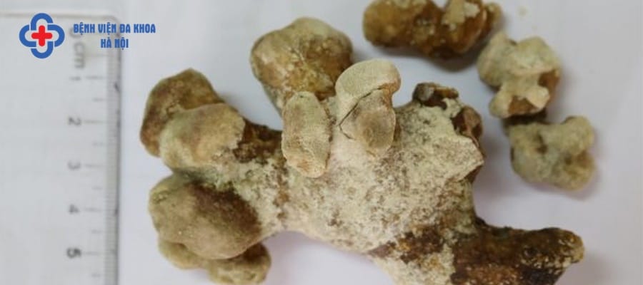 Sỏi struvite